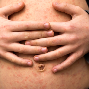 Detectan primer caso de sarampión en un pequeño de 4 años en la CDMX