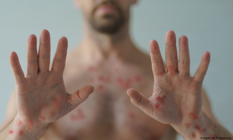Cepa "mutante" de viruela del mono con potencial pandémico enciende las alertas, van más de 100 casos