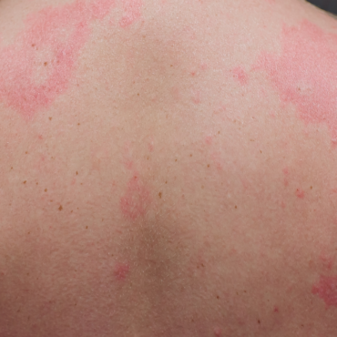 Aumentan casos de escarlatina en México