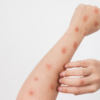 Alerta IMSS-Bienestar por síntomas de Mpox ante casos en México