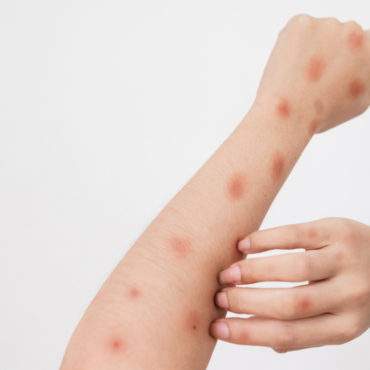 Alerta IMSS-Bienestar por síntomas de Mpox ante casos en México