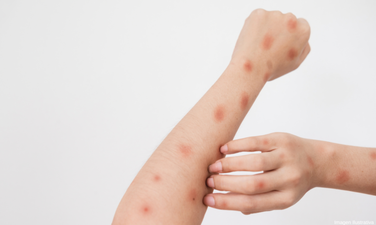 Alerta IMSS-Bienestar por síntomas de Mpox ante casos en México